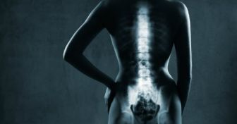Osteoporose:  Wenn die Knochen schwinden | apomio Gesundheitsblog
