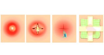 Abszess: Eine abgekapselte Eitersammlung | apomio Gesundheitsblog