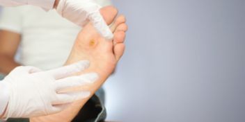 Hühneraugen: Die Verhornung richtig behandeln | apomio Gesundheitsblog