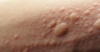 Nesselsucht und Quaddeln?! | apomio Gesundheitsblog