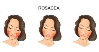 Couperose und Rosacea: Wissenswertes über die Hautkrankheit | apomio Gesundheitsblog