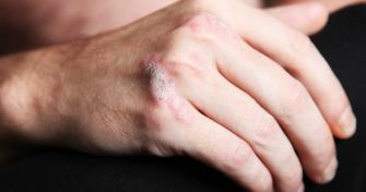 Psoriasis: Was bedeutet Schuppenflechte für Betroffene? | apomio Gesundheitsblog
