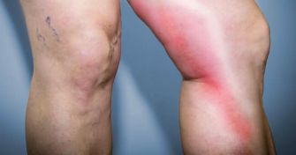 Venenentzündung: Wie entsteht eine Thrombophlebitis ? | apomio Gesundheitsblog