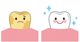 Zahnstein - Ursache und Behandlung | apomio Gesundheitsblog